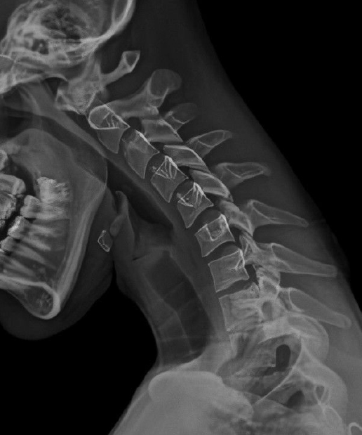 Spine X-Ray.