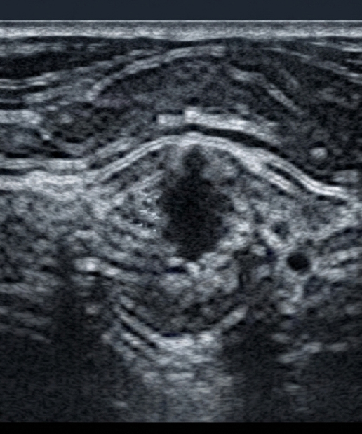 USG Breast