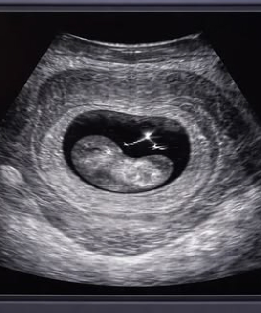 USG Obstetric
