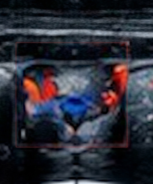 USG Thyroid