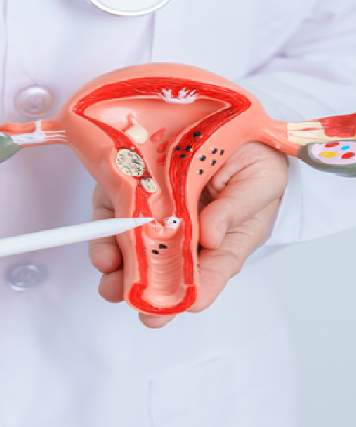 Fibroids