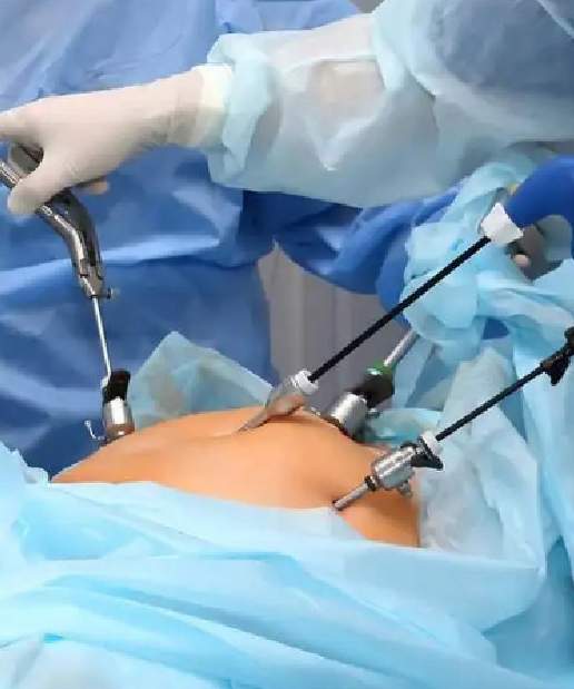 Laparoscopy