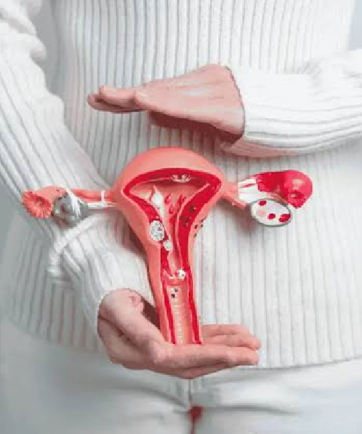 Ovarian cysts