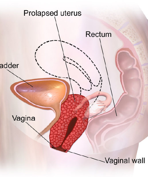 Uterine prolapse