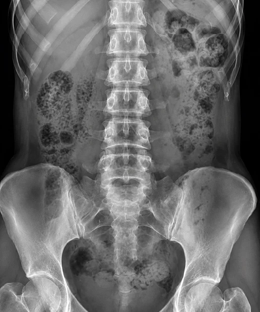 Abdomen X-Ray