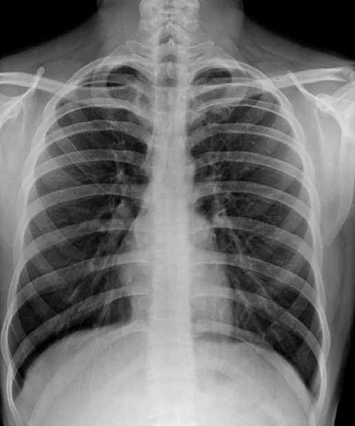 Chest X-Ray
