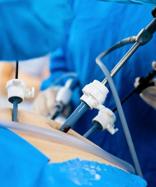 Hysterectomy (TLH)