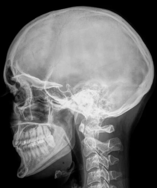 Skull X-Ray