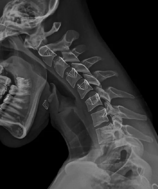 Spine X-Ray