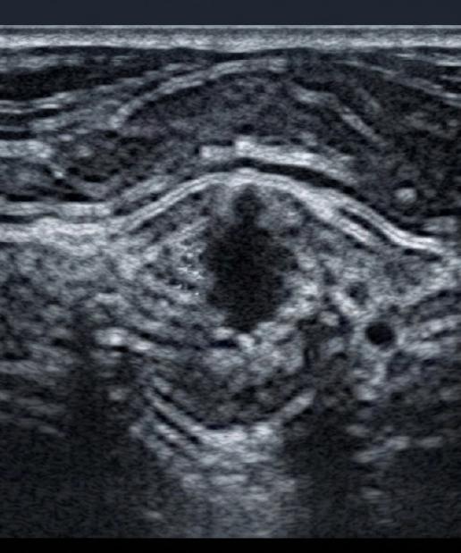USG Breast