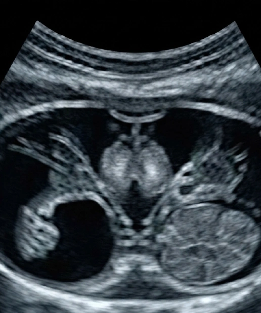 USG Pelvic