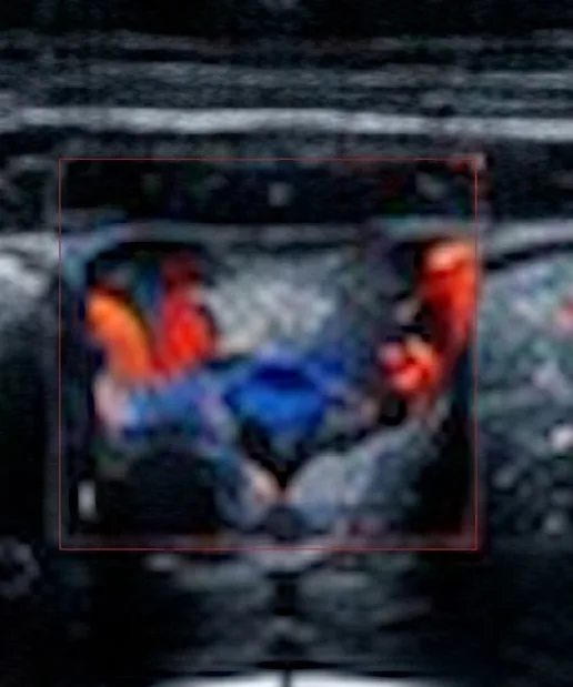 USG Thyroid
