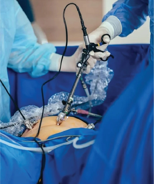 Laparoscopic Gynae Surgery