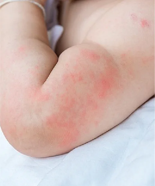 Respiratory and Allergy